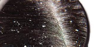 Berbagai Penyebab Rambut Rontok Di Masa Datang Bulan